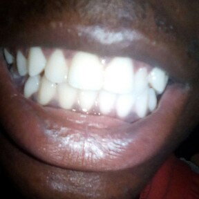 teeth mystery (EOP) 