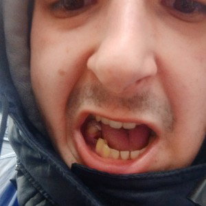 Венозный андер