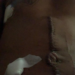 slide scars