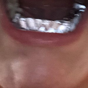 Staker