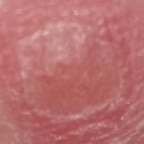 boil on the ass of the woman I love bacon saved her ass 