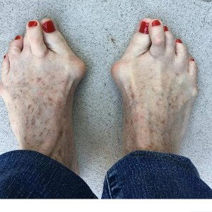 CROWS  FEET