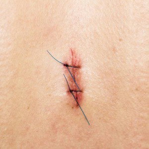 Heridas