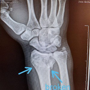 I took a risk to break my wrist