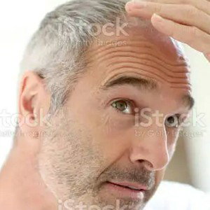 goin bald