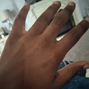 dark skin
