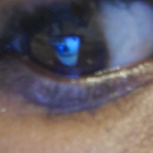 pain in my eyes 