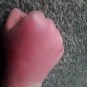 bleeding