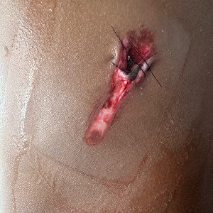 hole in my back