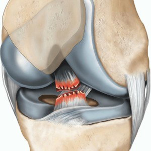 Dreaded ACL