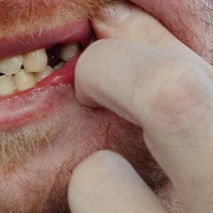 Shark Bite