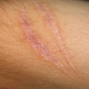 SCARS!
