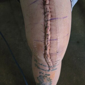 SCARS 