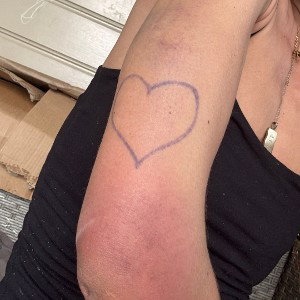 heart bruise