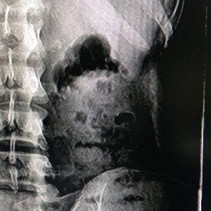X-Ray