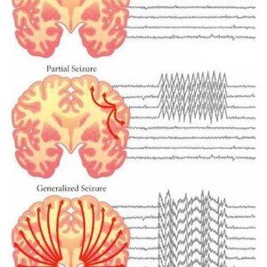 See Seizures
