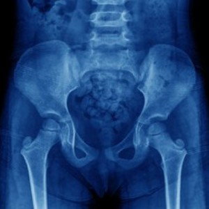 Gavi Long - broken hip 