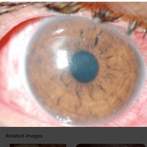 mace in my eye lids