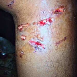 dog bite
