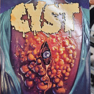 cyst