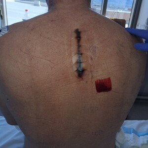 tumor on my spine