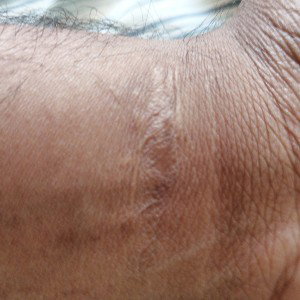 Scar