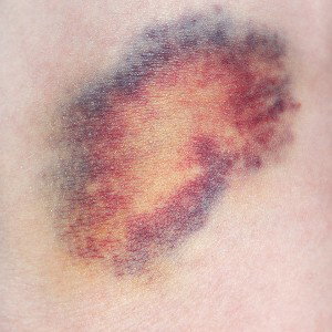 Bruises 