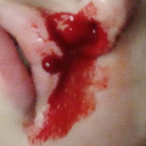 bloodshot