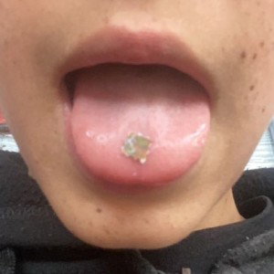 LSD