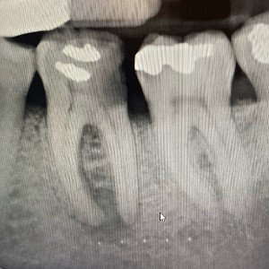 Xray