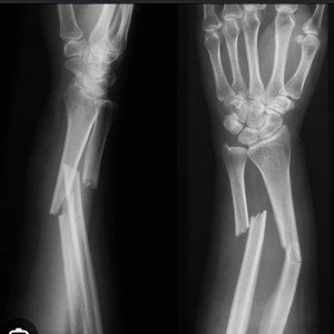 - 2 Rature + 2 Fracture lyrical