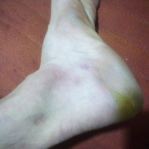 ankle biter 