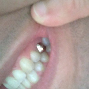 Dente Gold