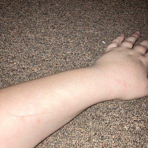 how I broke my arm and knee or leg